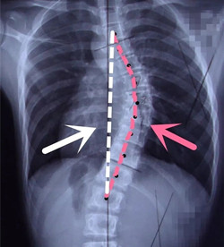 脊柱側(cè)彎后身高會(huì)變短嗎？