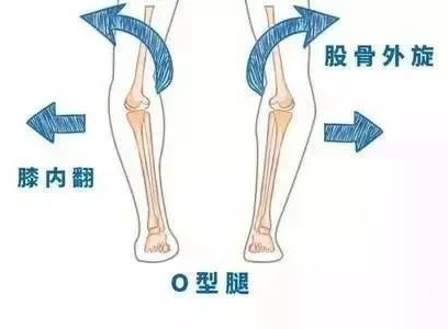 孩子“O”型腿怎么辦？