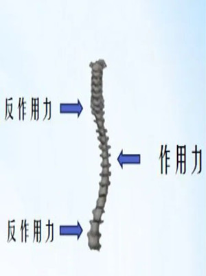 什么是脊柱側(cè)彎矯形器？